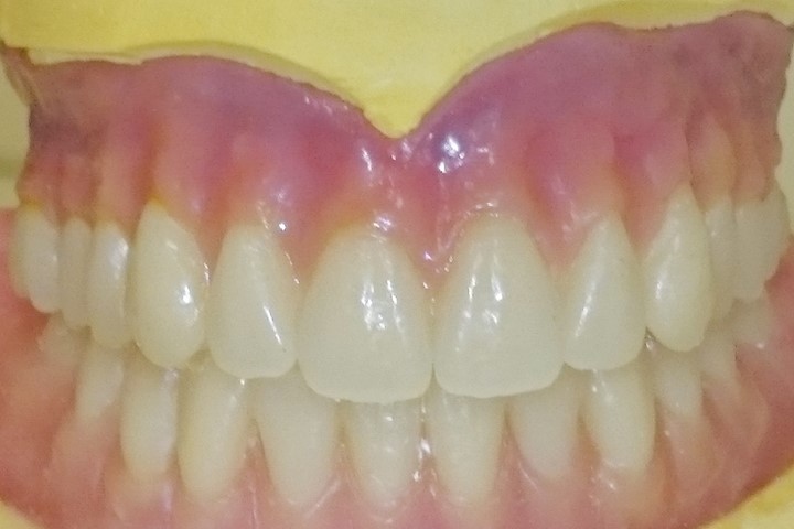 Metal Partial Dentures Hodges SC 29653